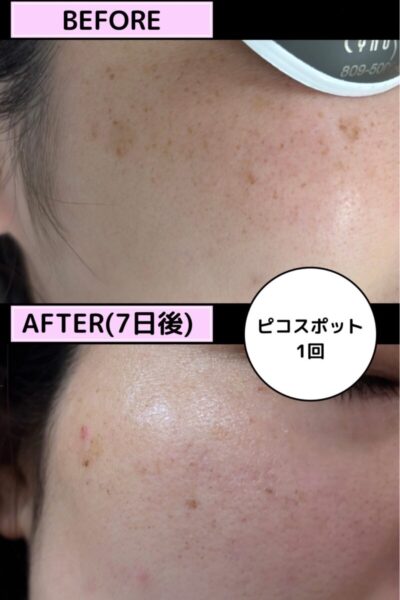 当日ピコレーザーも可能ですのアイキャッチ画像