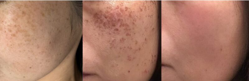 冬はシミ取りに最適の季節です