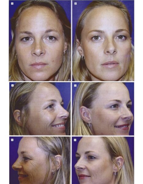 no BOTOX no LIFE！～ボトックスについて～