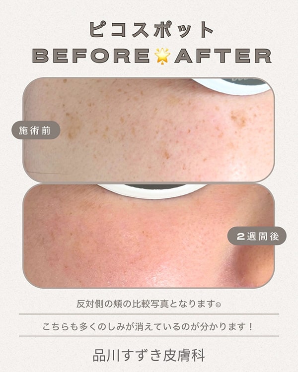 ピコスポットのBeforeAfter画像①