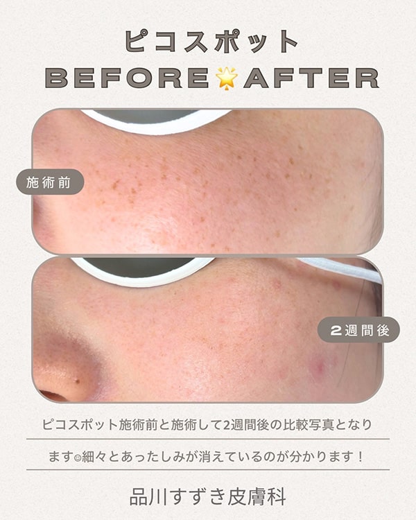 ピコスポットのBeforeAfter画像②