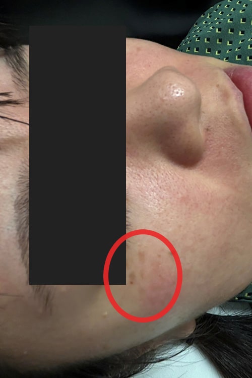 ADM（後天性真皮メラノサイトーシス）写真