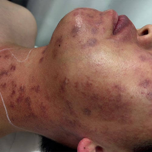 単純性血管腫(Vビーム治療前) 