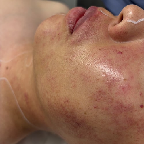 単純性血管腫(Vビーム治療後)
