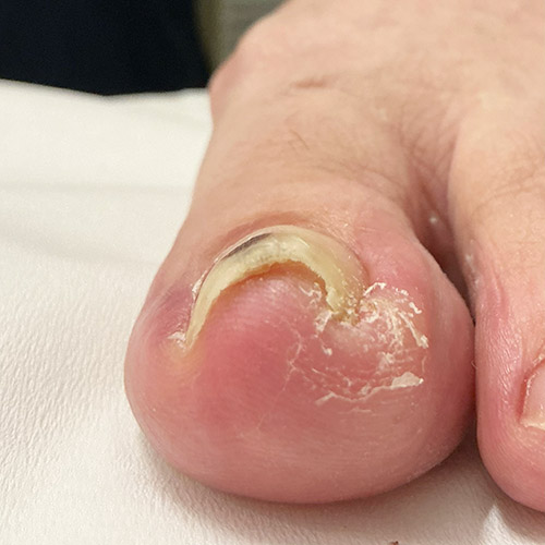 ニキビ(ざ瘡)写真