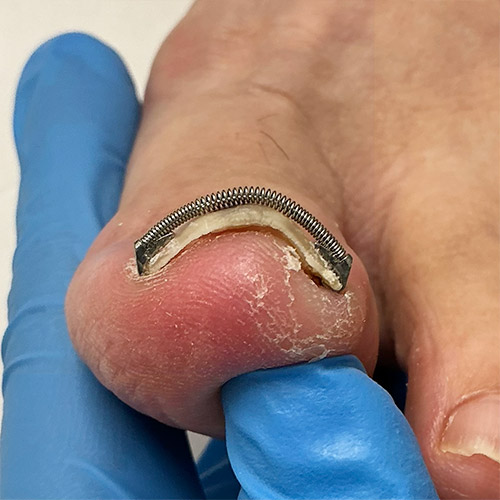 ニキビ(ざ瘡)写真