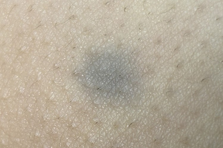 異所性蒙古斑の写真